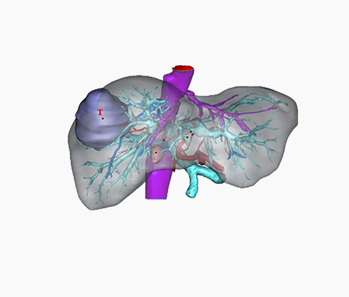 Virtual Surgery Planning (VSP)